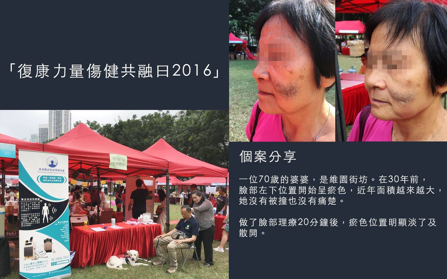 個案分享 – 20 分鐘改善臉部瘀傷