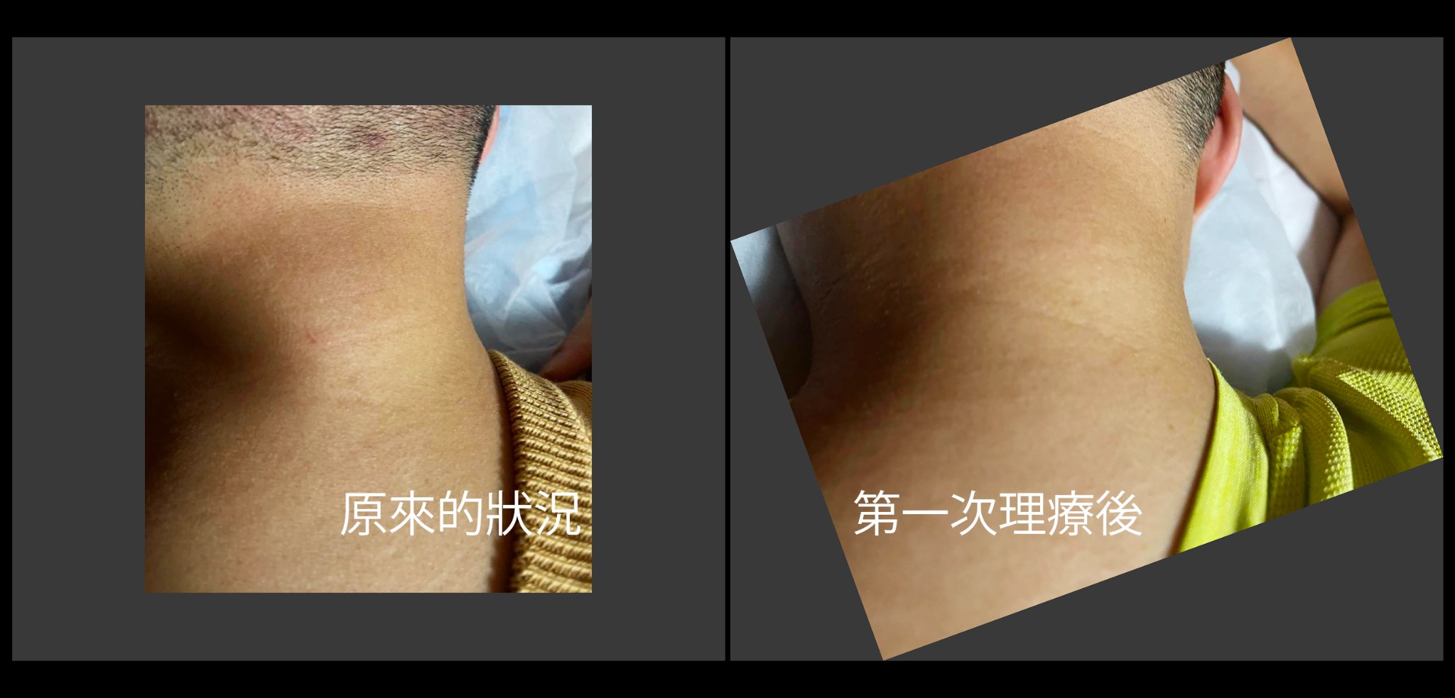 個案分享 – 富貴包 (Dowager’s Hump)